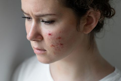 Frau hat Akne im Gesicht