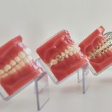 Drei Gebissmodelle für Zahnspangen