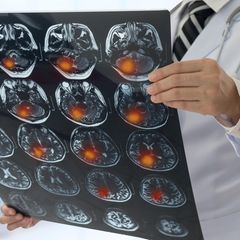 Hirnscan mit Tumor