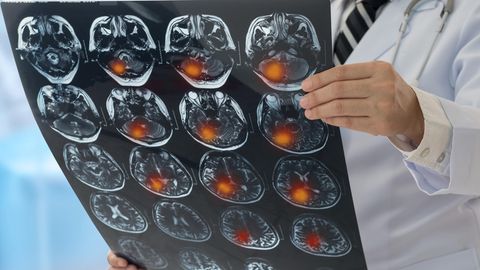 Hirnscan mit Tumor