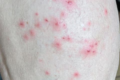 Hautausschlag durch Affenpocken-Infektion