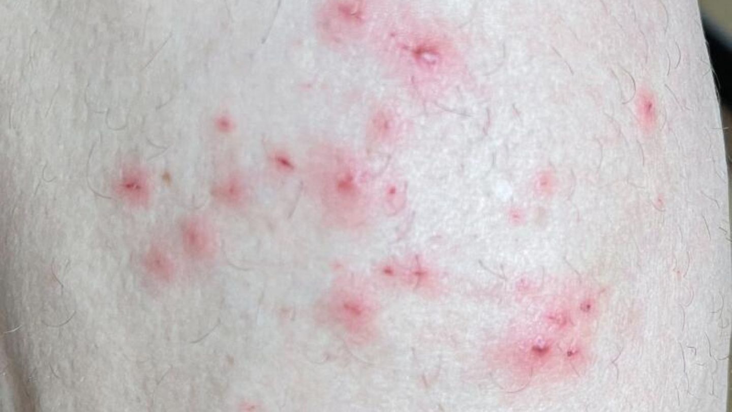 Hautausschlag durch Affenpocken-Infektion