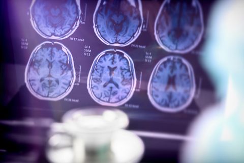 Aufnahmen vom Gehirn zur Untersuchung von Alzheimer im Krankenhaus