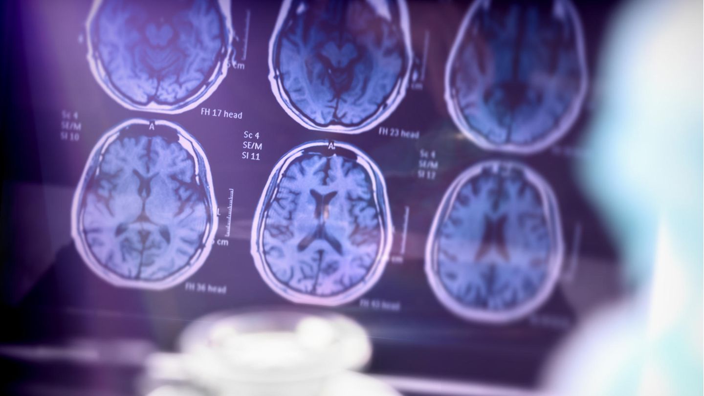 Aufnahmen vom Gehirn zur Untersuchung von Alzheimer im Krankenhaus Aufnahmen vom Gehirn zur Untersuchung von Alzheimer im Krankenhaus