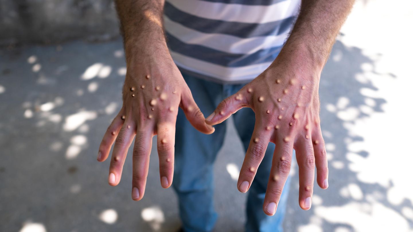 Monkey pox: doctor discovers infected people in the metro – the picture goes viral