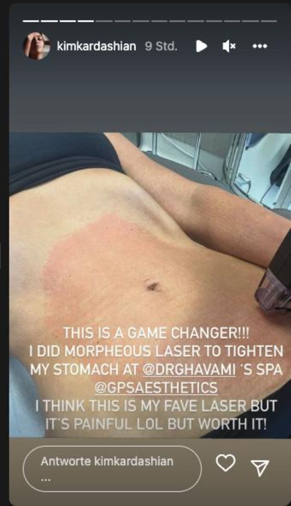 Kim Kardashians Bauch nach einer Laserbehandlung
