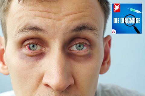 Mann mit stark geröteten Augen