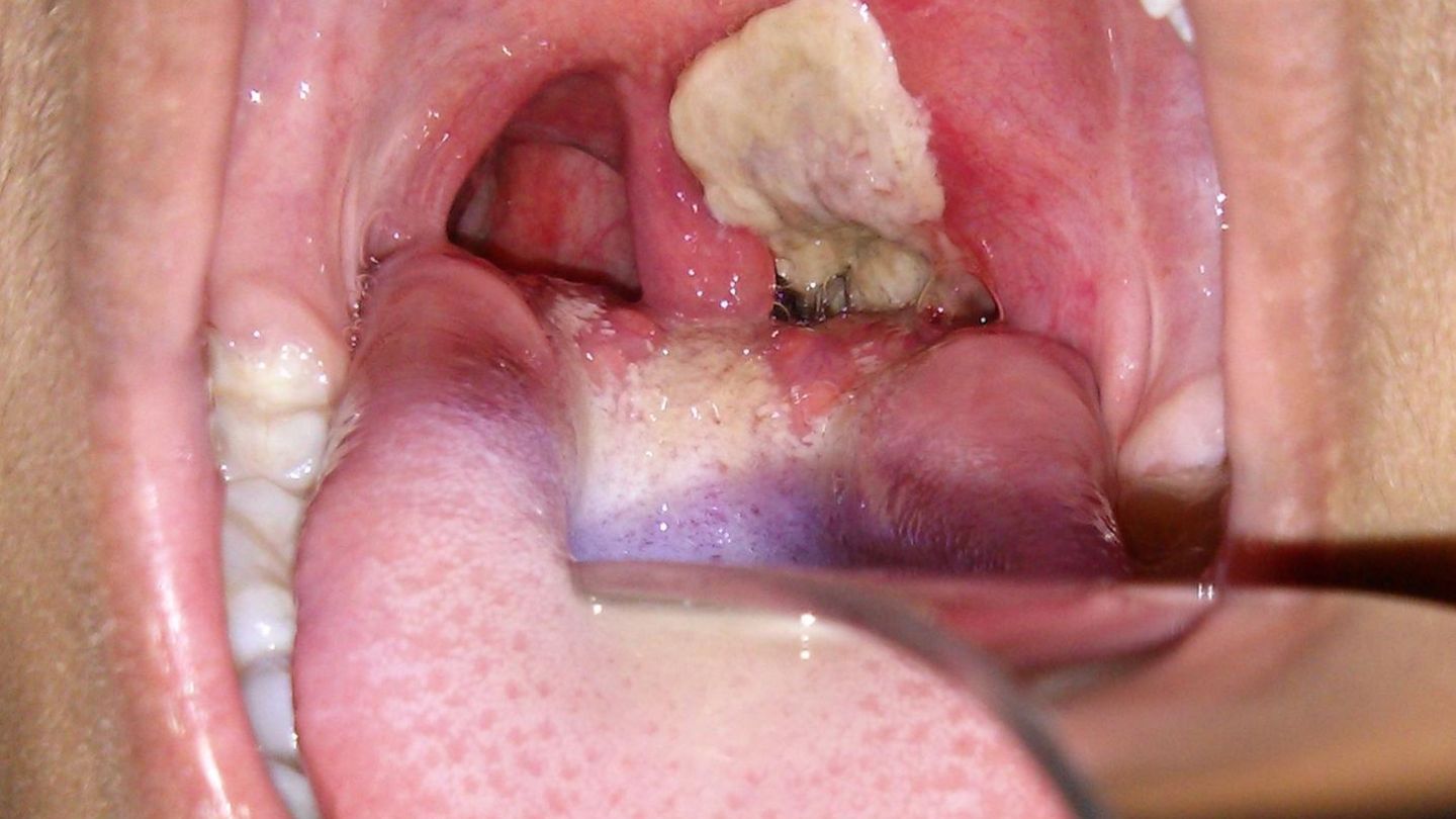 Diphtherie Impfung