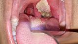 Diphtherie Impfung