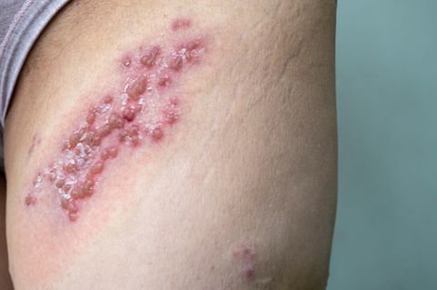 Impfung gegen Gürtelrose