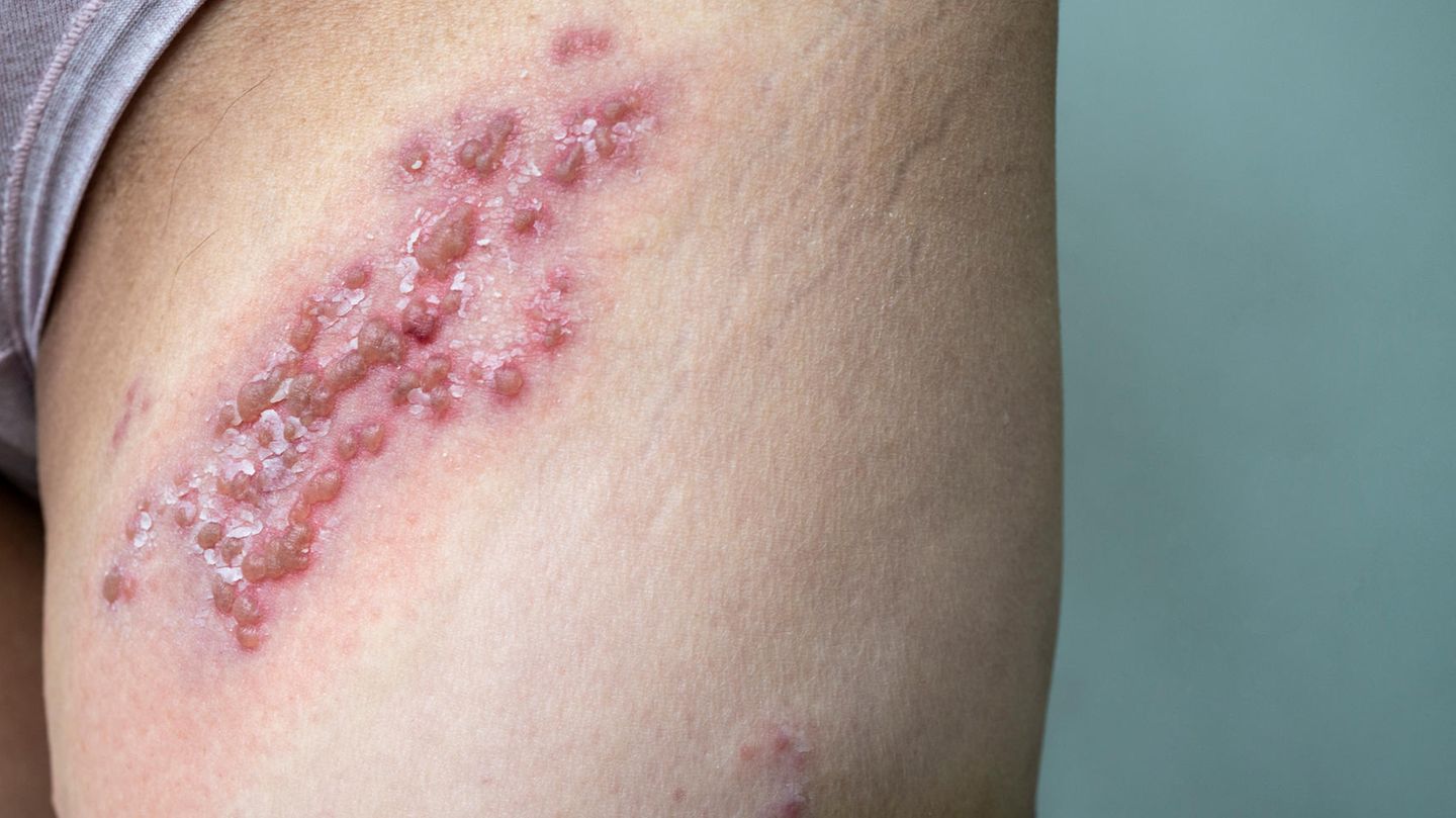 Vaccination against belt rose Vaccination against belt rose