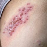 Impfung gegen Gürtelrose