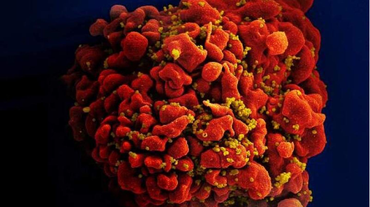 Darstellung einer mit HIV-infizierten Blutzelle Darstellung einer mit HIV-infizierten Blutzelle
