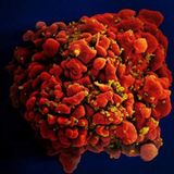 Darstellung einer mit HIV-infizierten Blutzelle