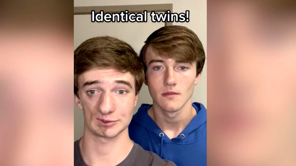 TikTok-Zwillinge klären über Parry-Romberg-Syndrom auf (Virales Video)