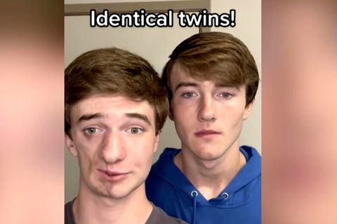 TikTok-Zwillinge klären über Parry-Romberg-Syndrom auf (Virales Video)