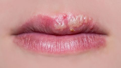 Gemein und manchmal gar Gefährlich: Herpes. Das Virus tritt häufig an den Lippen zu Tage, aber nicht nicht nur.