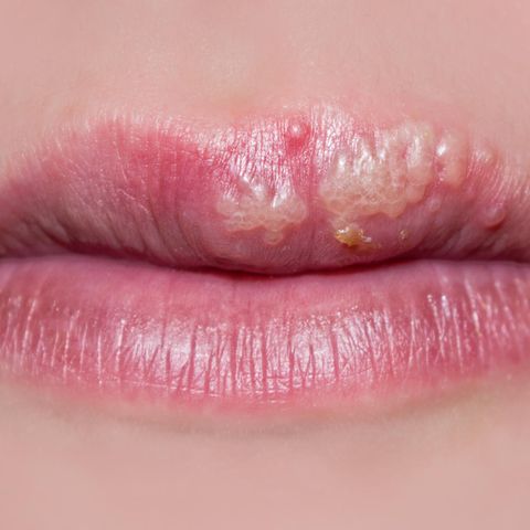 Gemein und manchmal gar Gefährlich: Herpes. Das Virus tritt häufig an den Lippen zu Tage, aber nicht nicht nur.