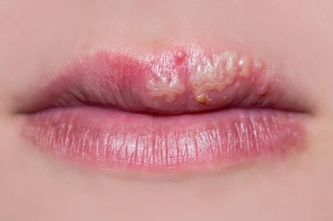 Gemein und manchmal gar Gefährlich: Herpes. Das Virus tritt häufig an den Lippen zu Tage, aber nicht nicht nur.