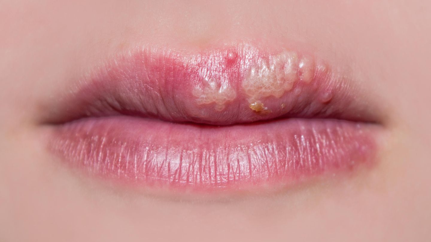 Herpes: Warum die Bläschen an Lippen nur einige Menschen quälen 