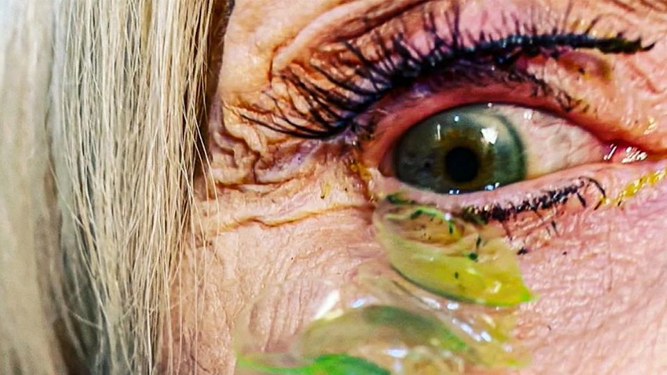 23 Kontaktlinsen im Auge: Ärztin entfernt Patientin nach starken Schmerzen zahlreiche Sehhilfen 23 Kontaktlinsen im Auge: Ärztin entfernt Patientin nach starken Schmerzen zahlreiche Sehhilfen