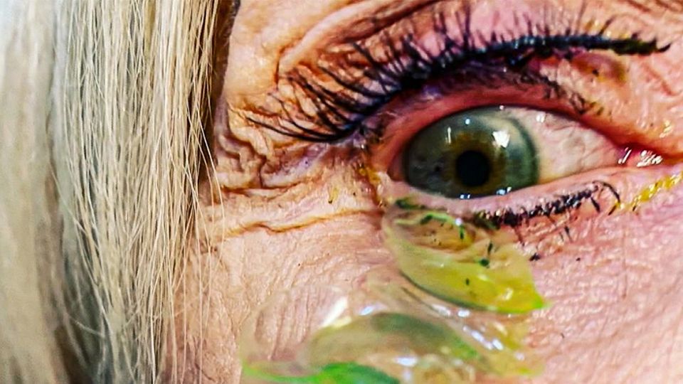 Ekel-Video: Ärztin entfernt Patientin 23 Kontaktlinsen aus Auge