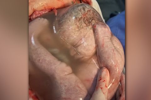 Besondere Geburt: Baby kommt in intakter Fruchtblase zur Welt