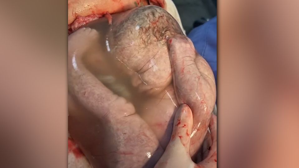 Besondere Geburt: Baby kommt in intakter Fruchtblase zur Welt Besondere Geburt: Baby kommt in intakter Fruchtblase zur Welt