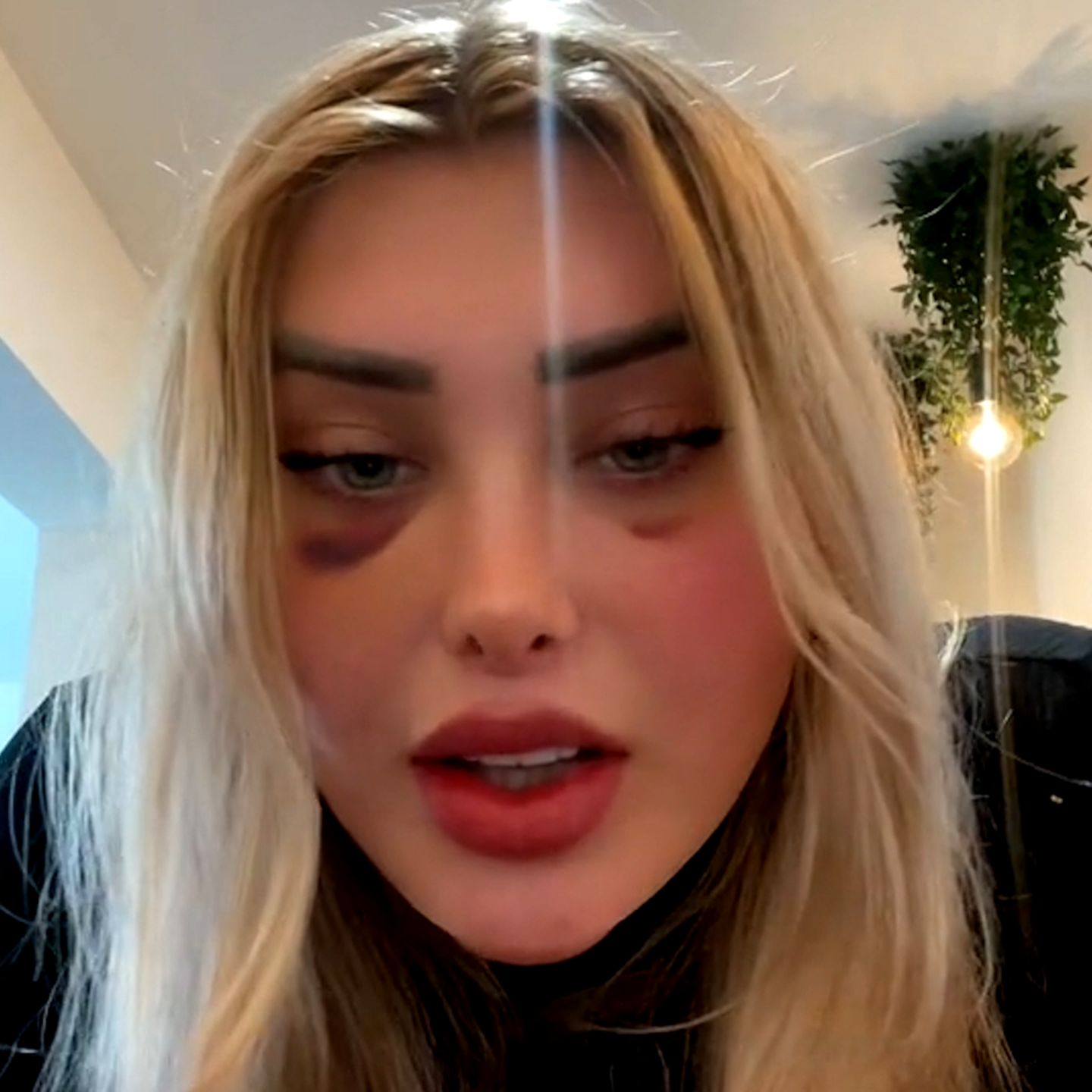 Influencerin zeigt extrem geschwollenen Kopf nach Schönheits-OP | STERN.de