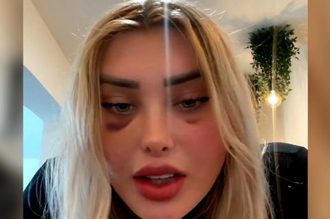 Nach Schönheits-OP: Influencerin über Horror-Erfahrung im Flugzeug