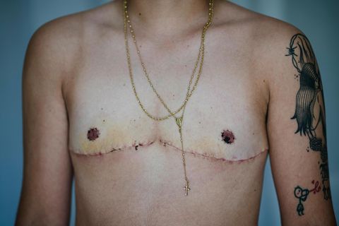 Foto einer abgenommenen Brust