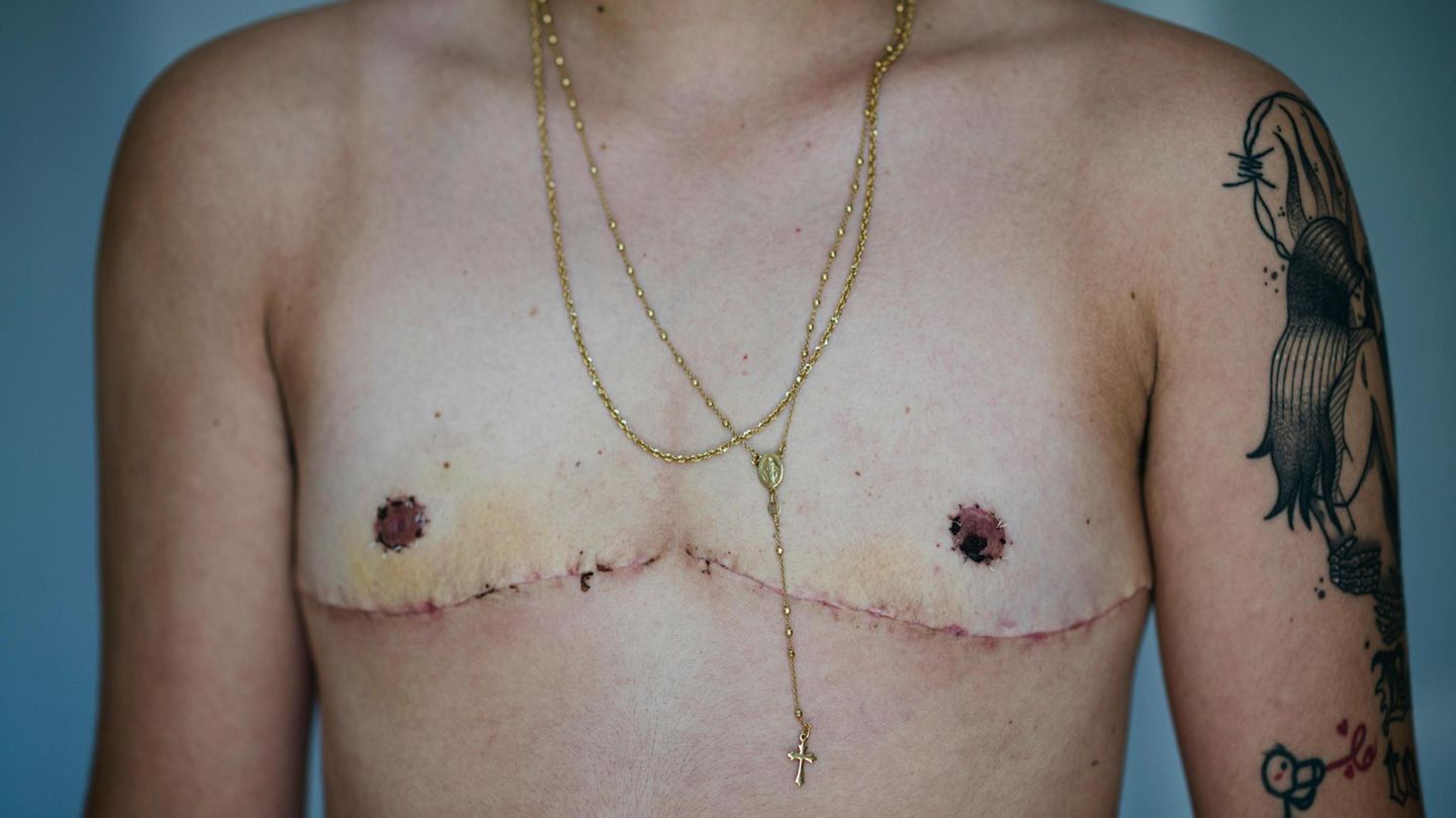 Foto einer abgenommenen Brust Foto einer abgenommenen Brust