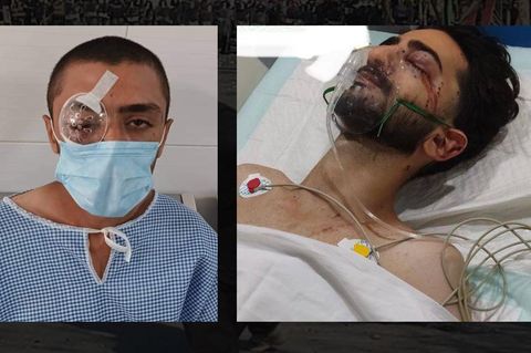 Patienten mit verletzten und blutenden Augen