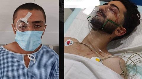 Patienten mit verletzten und blutenden Augen