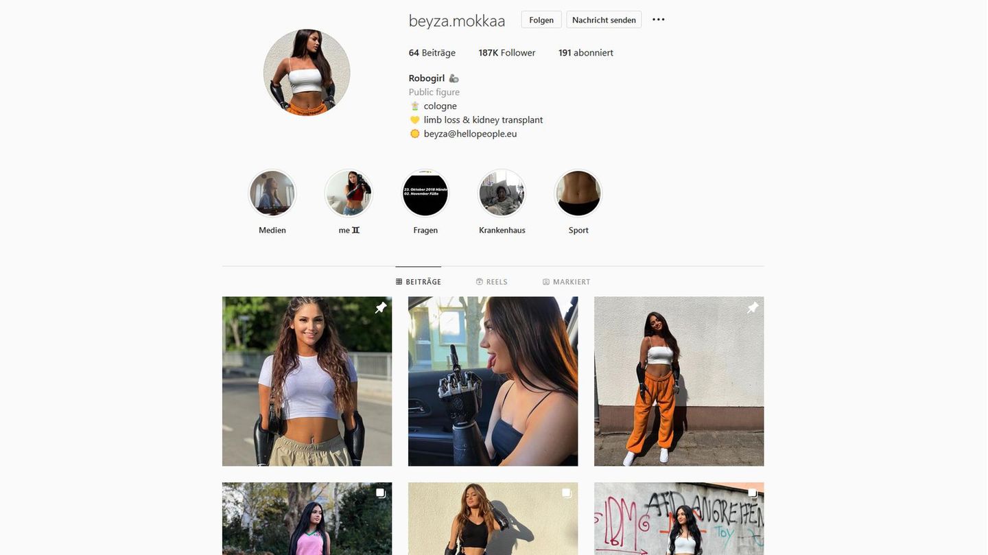 Beyza Mokka verlor durch eine Hirnhautentzündung Arme und Beine Beyza Mokka verlor durch eine Hirnhautentzündung Arme und Beine