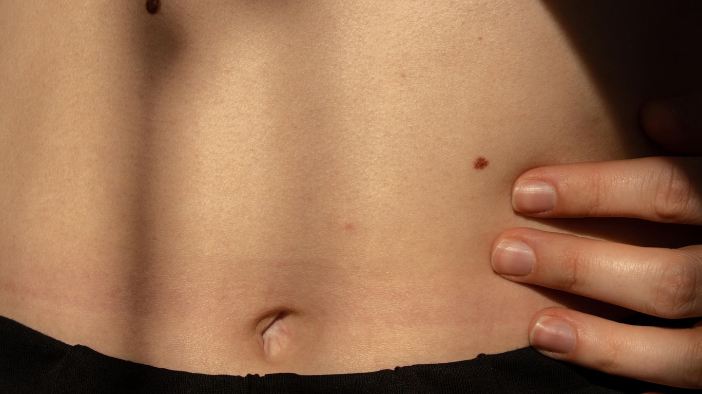 Frau mit Muttermal