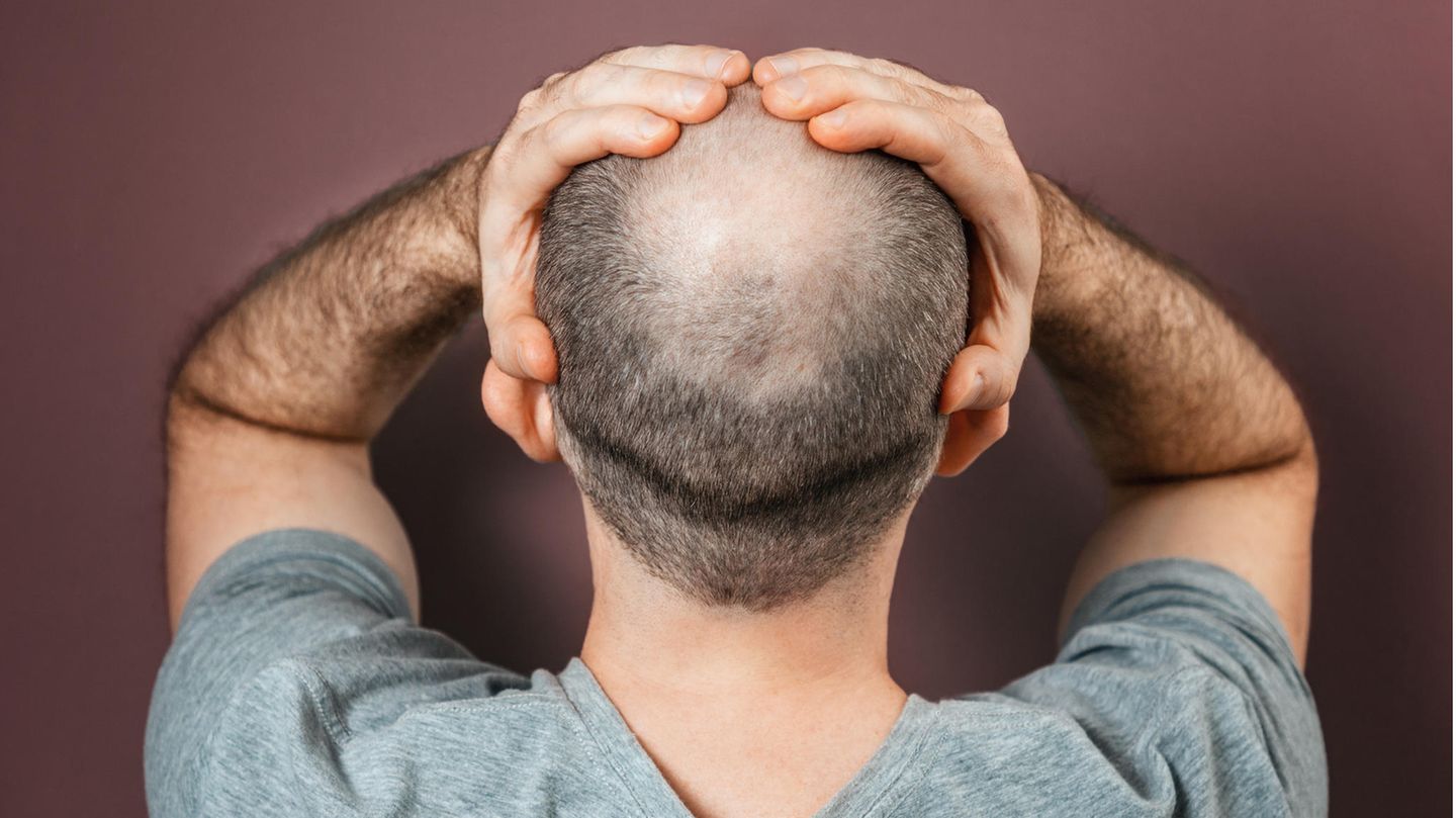 Study: Hair loss in men: Study discovers new cause of hair loss