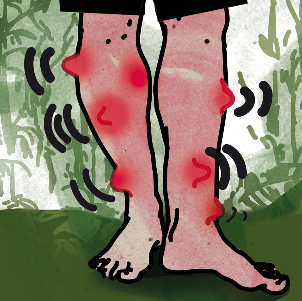 Illustration von Unterschenkeln die mit roten Beulen übersät sind