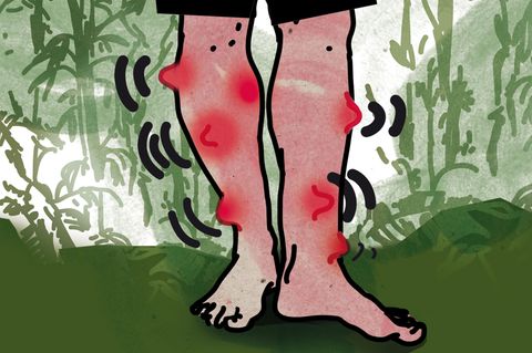 Illustration von Unterschenkeln die mit roten Beulen übersät sind  Illustration von Unterschenkeln die mit roten Beulen übersät sind