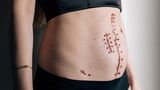 Endometriose: Die Fotografin Jasmin Breidenbach zeigt, wie sich Endometriose für Betroffene wirklich anfühlt