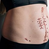 Endometriose: Die Fotografin Jasmin Breidenbach zeigt, wie sich Endometriose für Betroffene wirklich anfühlt