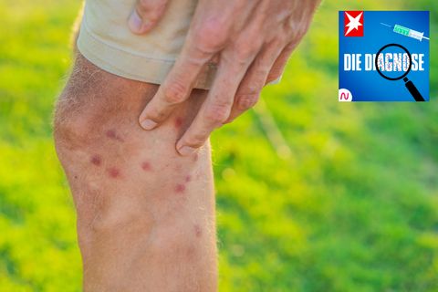 Ein Mann hat wachsende Beulen an den Beinen, die stechend schmerzen.