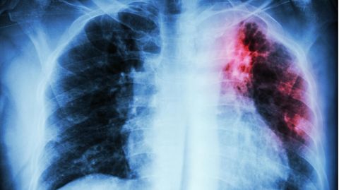 Tuberkulose auf einem Scan der Lunge.