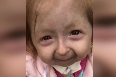 Benjamin-Button-Syndrom: Die Sechsjährige Isla hat Progerie