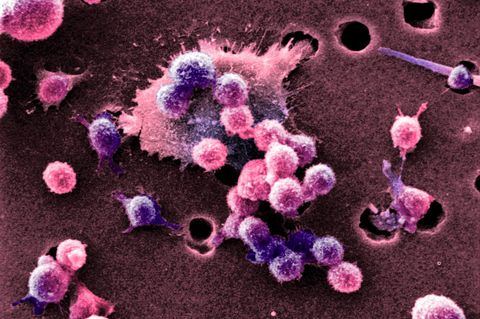 Aufnahme eines Burkitt-Lymphoms mit dem Rasterelektronenmikroskop