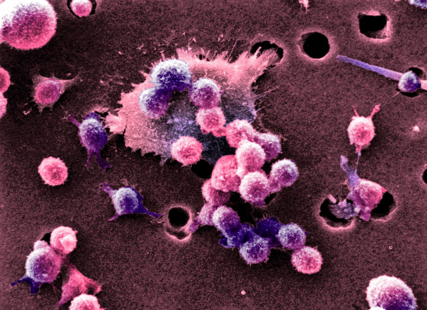 Aufnahme eines Burkitt-Lymphoms mit dem Rasterelektronenmikroskop
