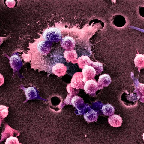 Aufnahme eines Burkitt-Lymphoms mit dem Rasterelektronenmikroskop