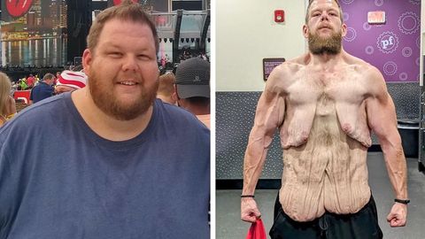 Mega-Verwandlung: Mann zeigt Nebenwirkungen seines Gewichtsverlusts