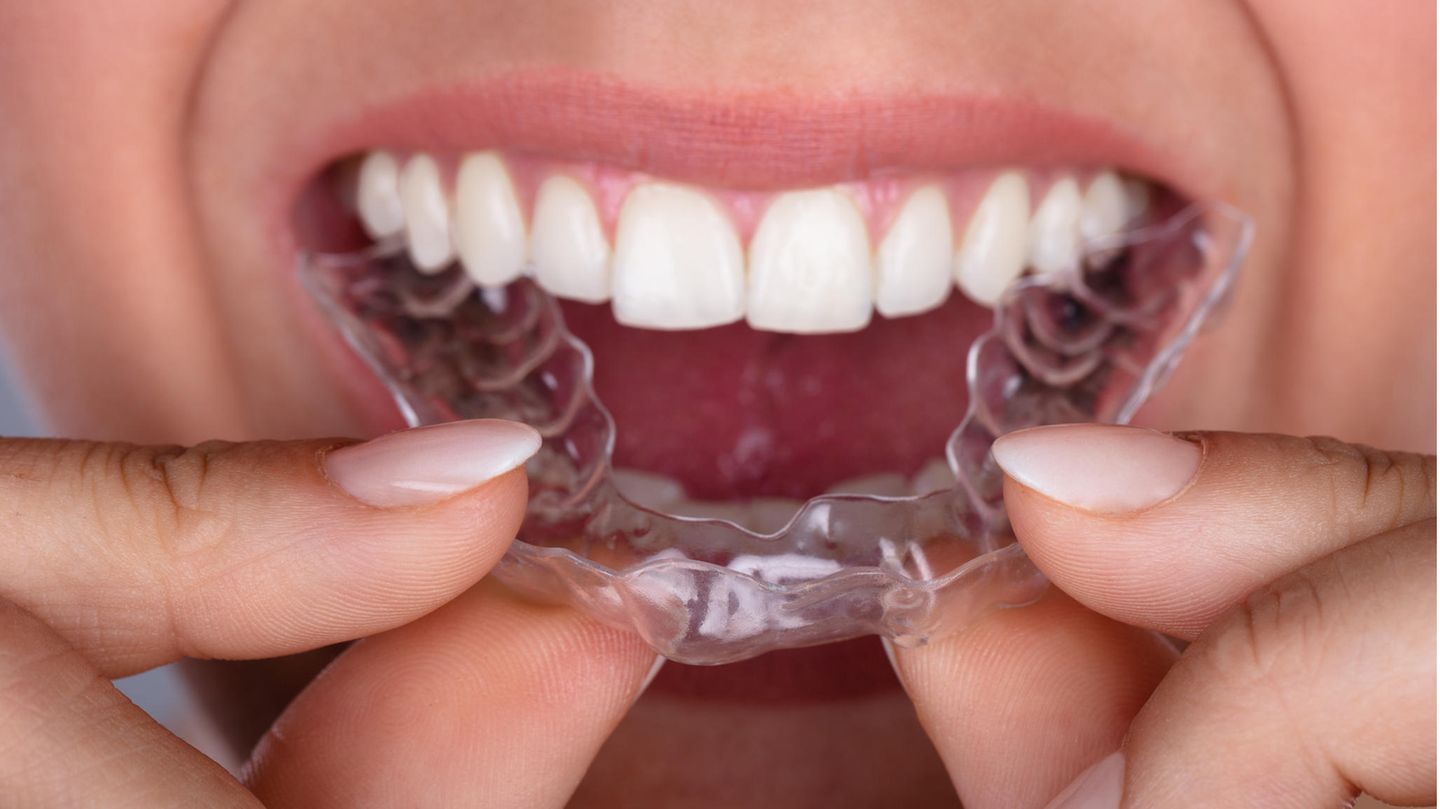 Braces as adults: why I’m wearing braces again in my early 30s