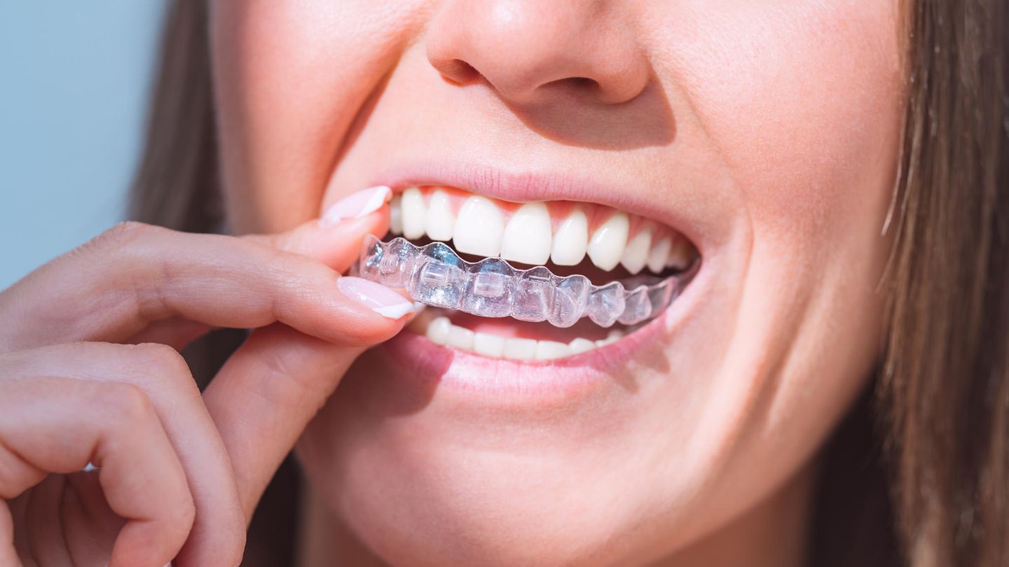 Braces for adults: what to consider beforehand